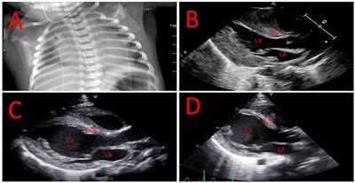 Infantile-onset Pompe disease complicated by sickle cell anemia: Case report and management considerations